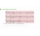 آموزش تفسیر ﻿Electrocardiogram (ECG) در تشخیص و درمان بیماریهای قلب 5